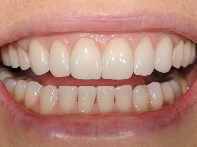 after cosmetic dentistry in Alpharetta, GA