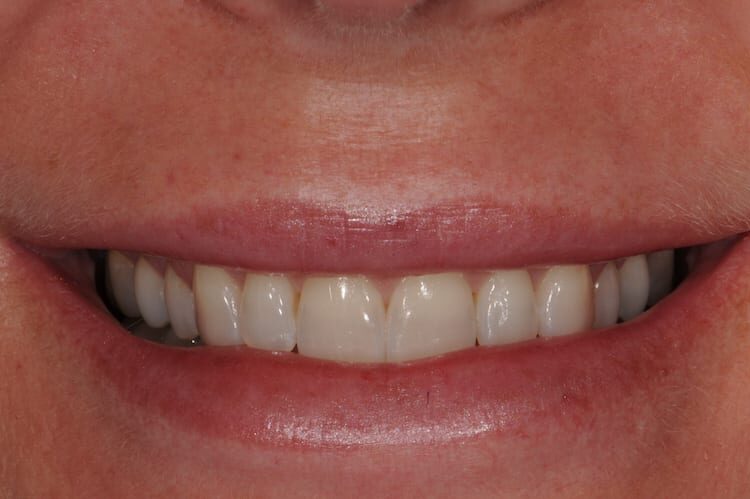 before cosmetic dentistry in Alpharetta, GA