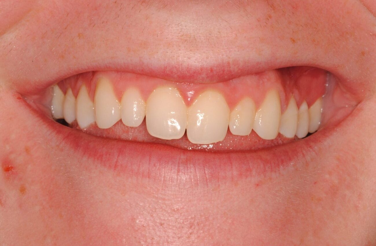 before cosmetic dentistry in Alpharetta, GA