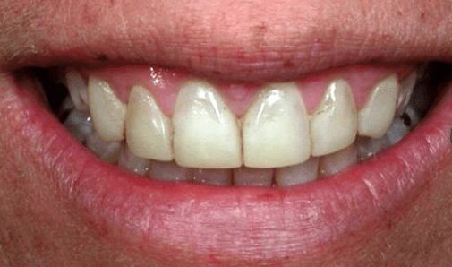 before cosmetic dentistry in Alpharetta, GA