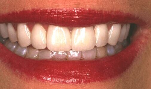 after cosmetic dentistry in Alpharetta, GA