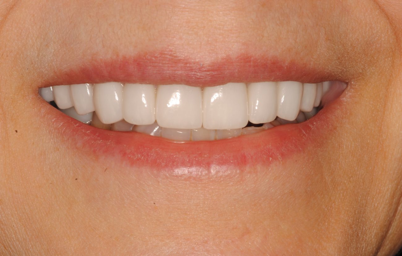 after cosmetic dentistry in Alpharetta, GA